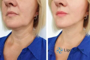 Double chin before and after Hi-Fu treatment 4 Book your double chin treatment Llanelli today! We are here to help!