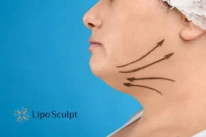Double chin before and after Hi-Fu treatment 3 Boost your confidence with a Double chin treatment Llanelli
