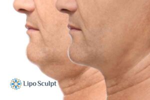 Double chin before and after Hi-Fu treatment 2 Double chin treatment Llanelli from Lipo Sculpt - feel more confident today!