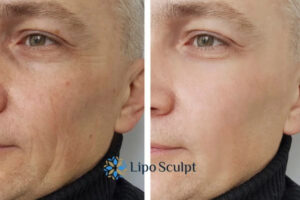 How to Fight Aging Symptoms 3 Fight Aging Symptoms Llanelli With HIFU and Morpheus8 Today!
