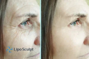 How to Fight Aging Symptoms 2 Do you want to Fight Aging Symptoms Llanelli? Contact Lipo Sculpt today!