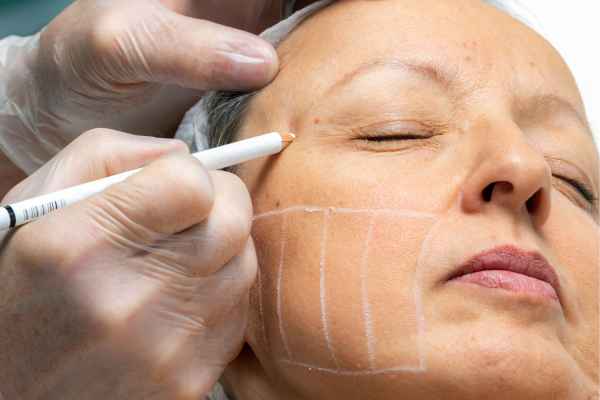 CryoPen: 5 Skin Concerns It May Be Used to Treat 4 What should you ask before having CryoPen treatment Llanelli?