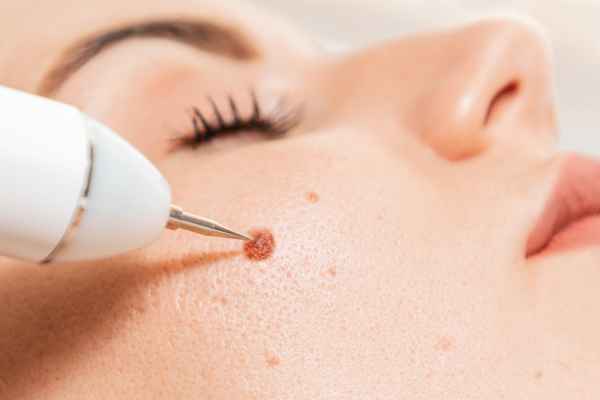 CryoPen: 5 Skin Concerns It May Be Used to Treat 3 What actually happens during a CryoPen treatment Llanelli?