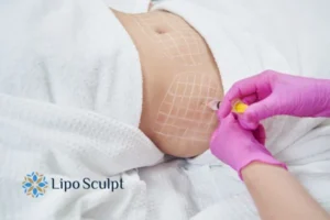 Are The Results From Aqualyx Permanent? 1 Do you want to know how long Aqualyx Llanelli results last?