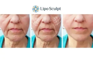 Explaining Morpheus8 And What It Can Do For You 3 Boost your confidence with Morpheus8 Llanelli call our team today!