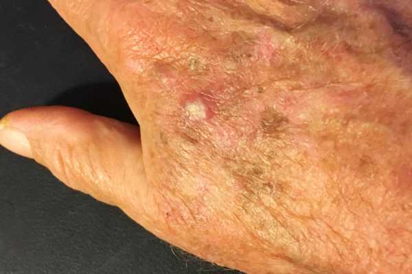 Actinic Keratoses: Treatment Options and What You Need to Know 4 actinic keratoses removal