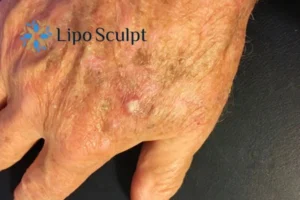 Best Actinic Keratoses Removal 2 Improve your wellbeing and health with Actinic Keratoses Llanelli removal.treatment