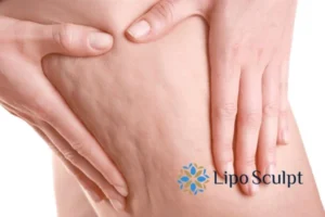 CoolSculpting for Legs: The Innovative Approach to Redefining Your Legs 5 Start your journey today book your coolsculpting treatment Llanelli online today!