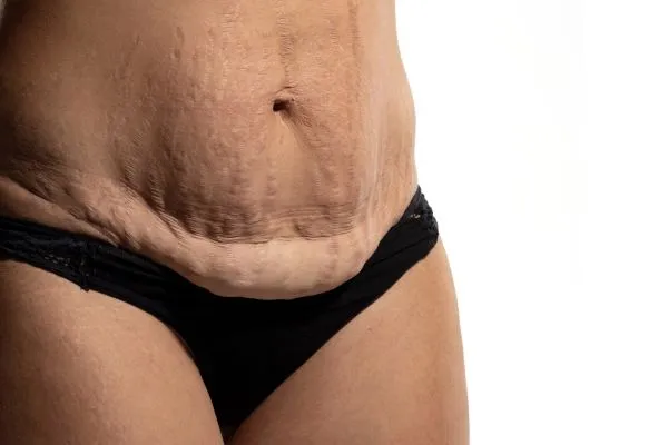 Lost the Weight but Not the Loose Skin? 1 image of womans stomach after weight loss showing loose skin Llanelli